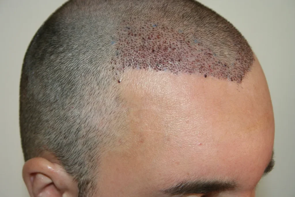 Fue 1000 Grafts: Amazing Before & After