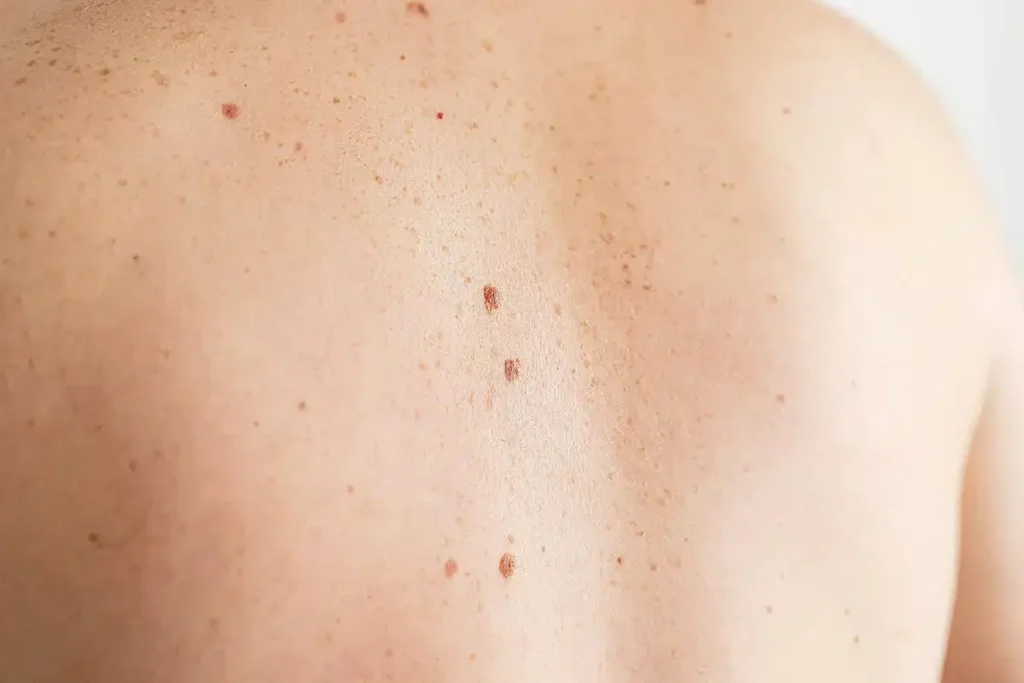 What Are These Brown Dots On My Skin? Secrets