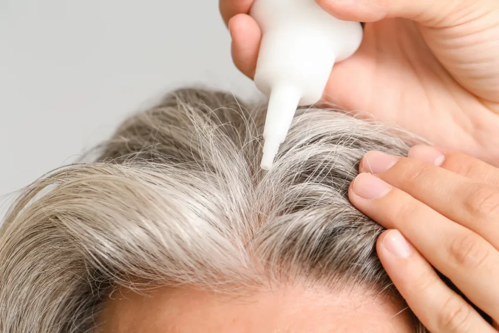 Is Minoxidil Safe For Women? Vital Guide