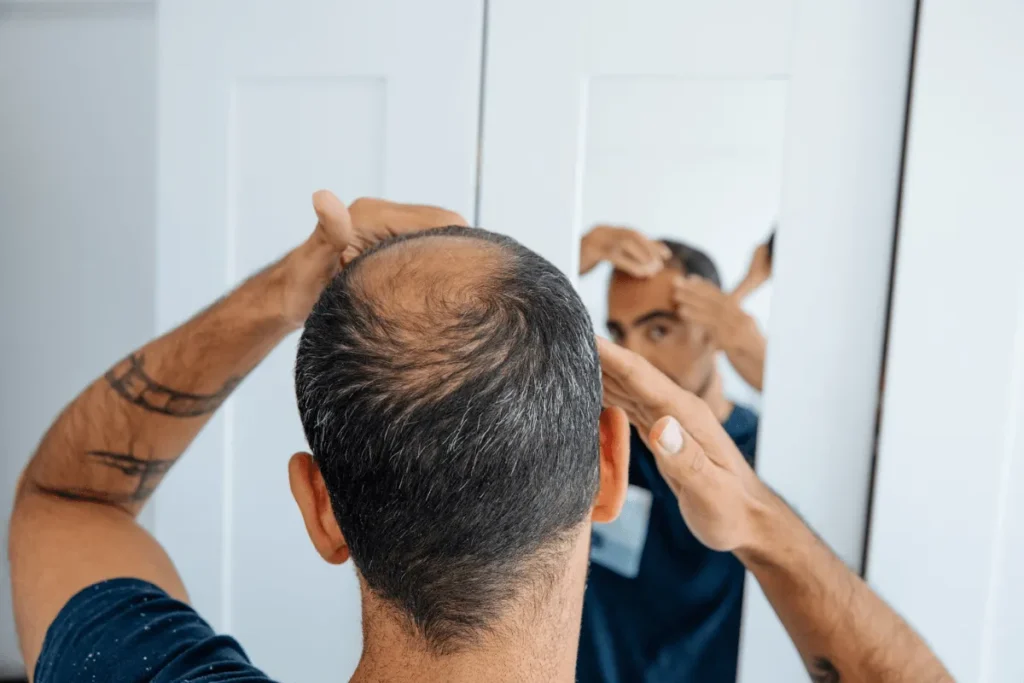 Male Baldness Stages: Essential Guide