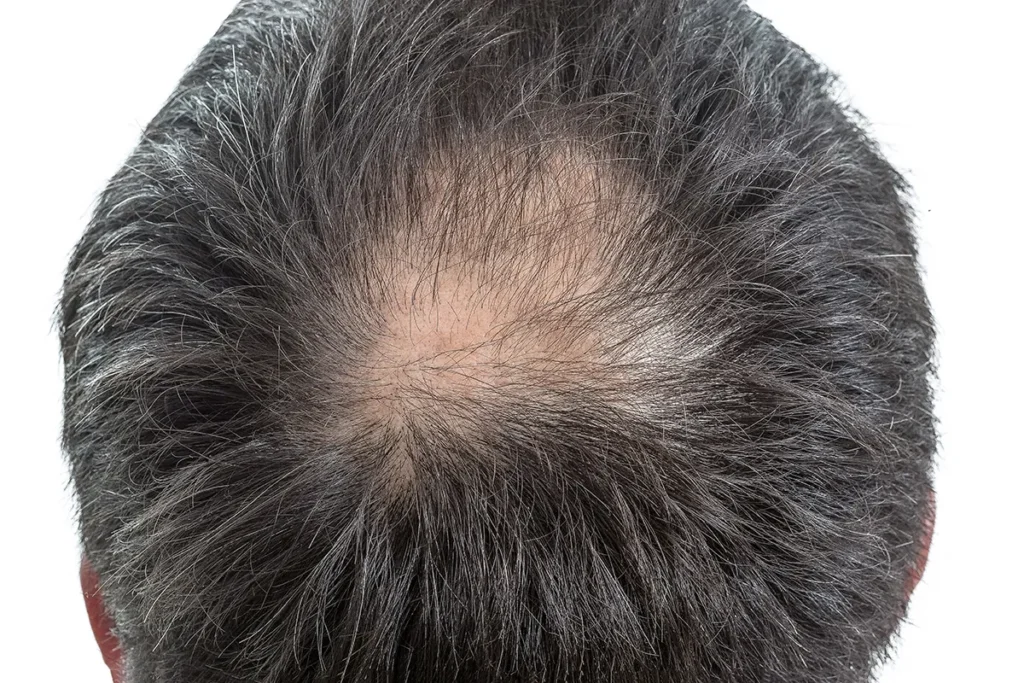 Minoxidil For Alopecia: Powerful Results
