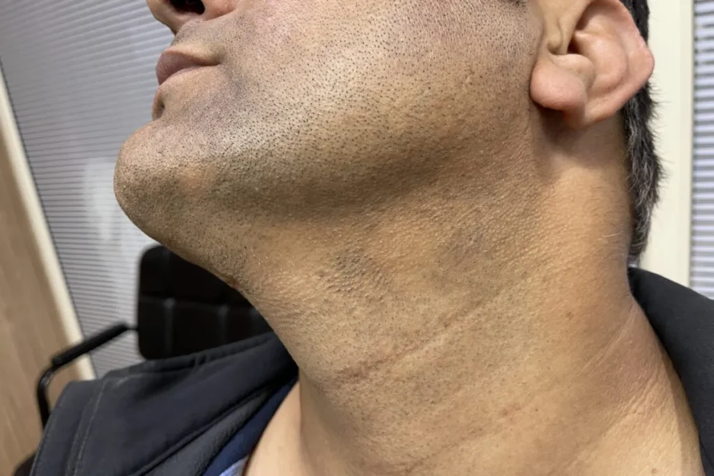 Mustache Bald Spot: Amazing Fast Fixes