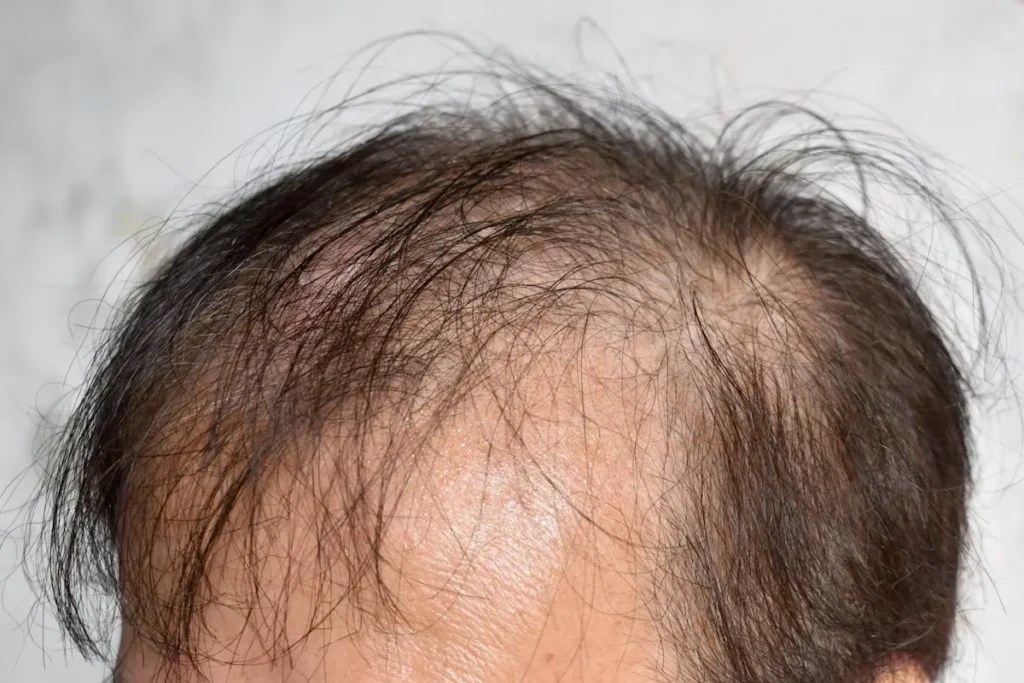 Stage 4 Baldness: Best Effective Ways