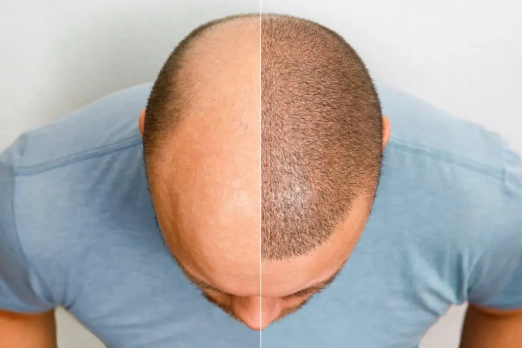 Types Of Hair Transplant: Best Success
