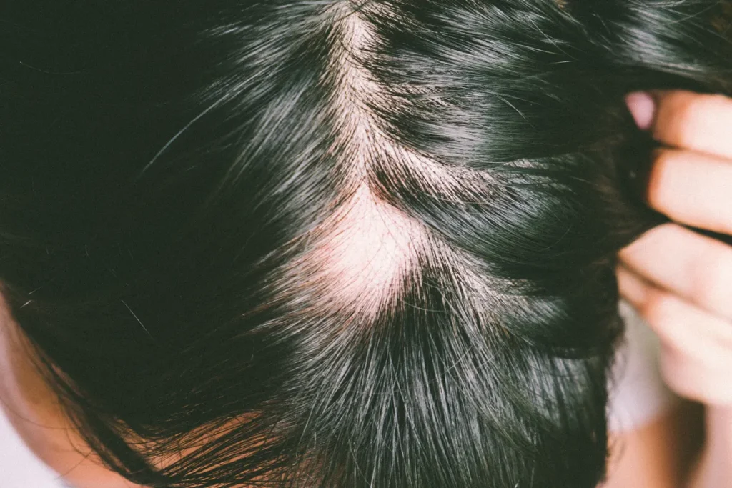 Alopecia Treatment Cream: Best Topical Fix