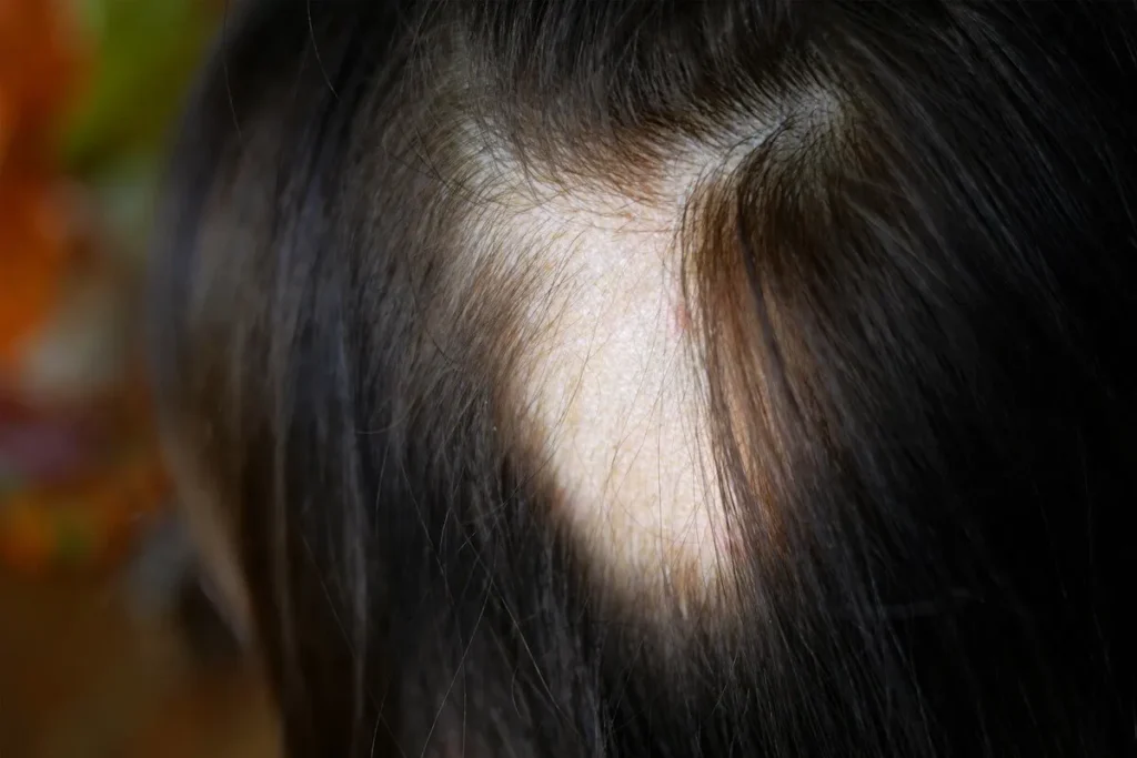 Are You Born With Alopecia? The Real Truth