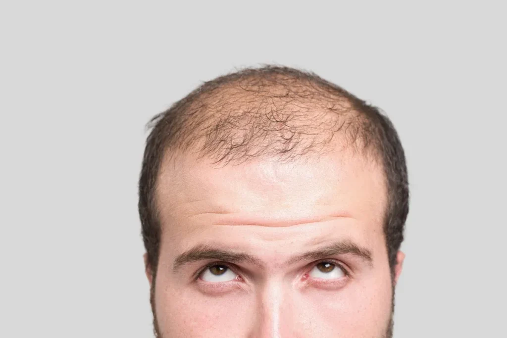 Beginning Of Balding: Best Early Signs