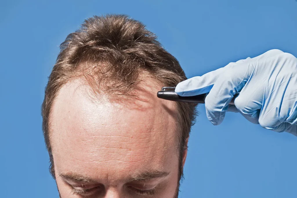 Best Hair Replacement Methods: Top Choices