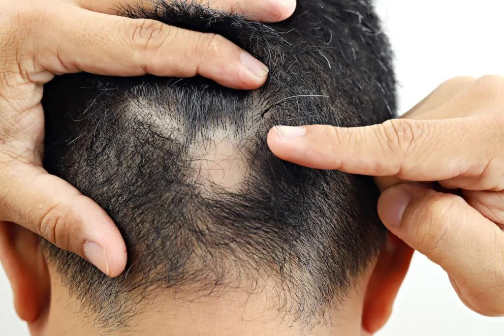 Does Alopecia Go Away? Best Proven Facts