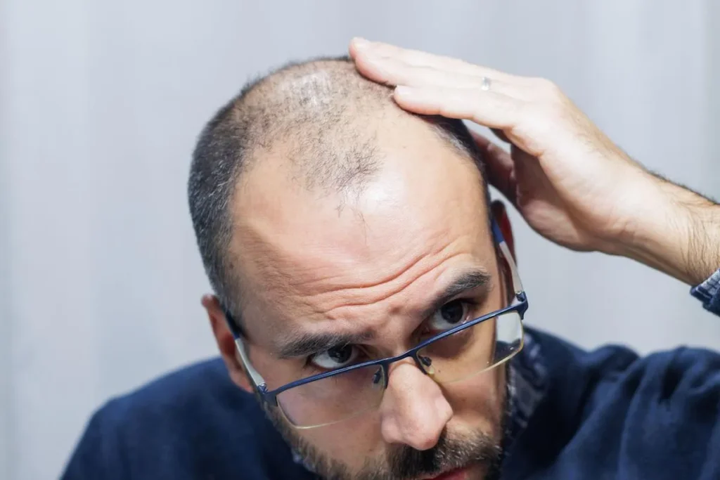 Does Finasteride Work? Amazing Proof Inside