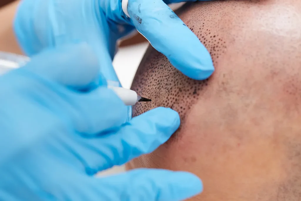 Non Surgical Hair Restoration Procedure