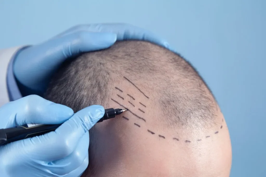 Non Surgical Hair Transplant: Best Fix