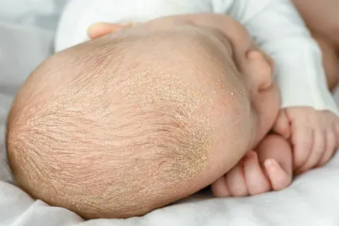 Small Bald Spot On Scalp Child: Fast Help