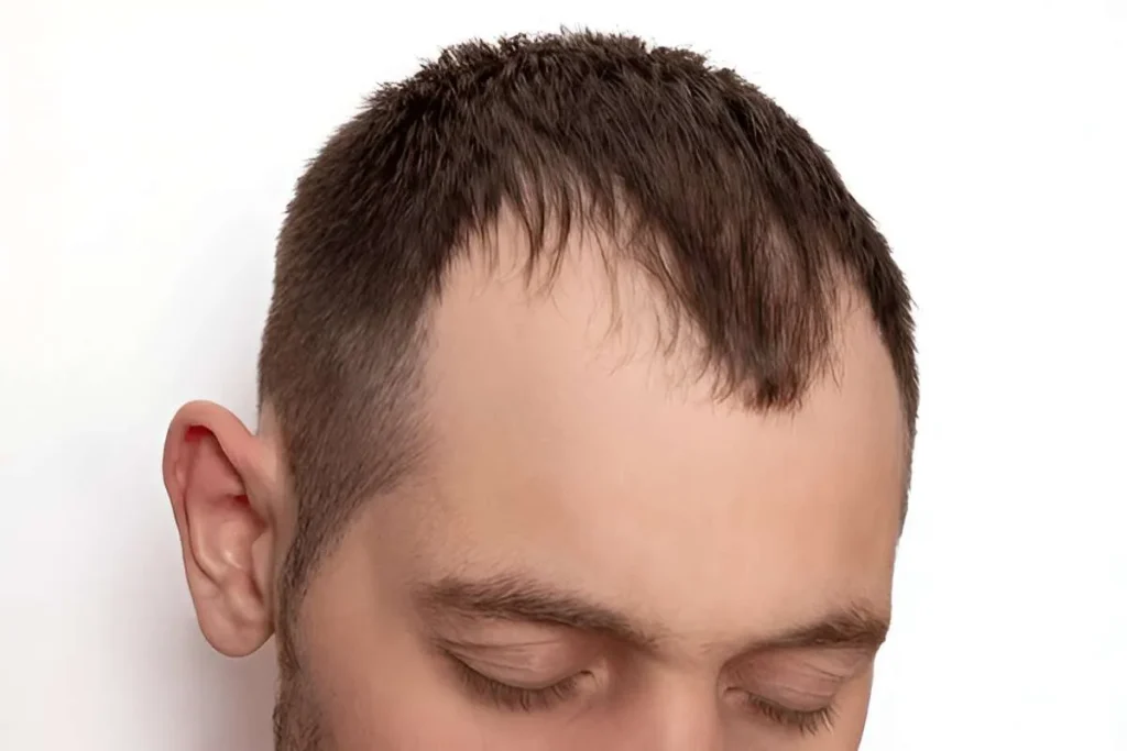 Stage 2 Hair Loss: Incredible Tips To Fix
