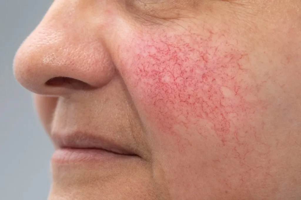 Why Is My Old Scar Turning Red? Vital Secrets