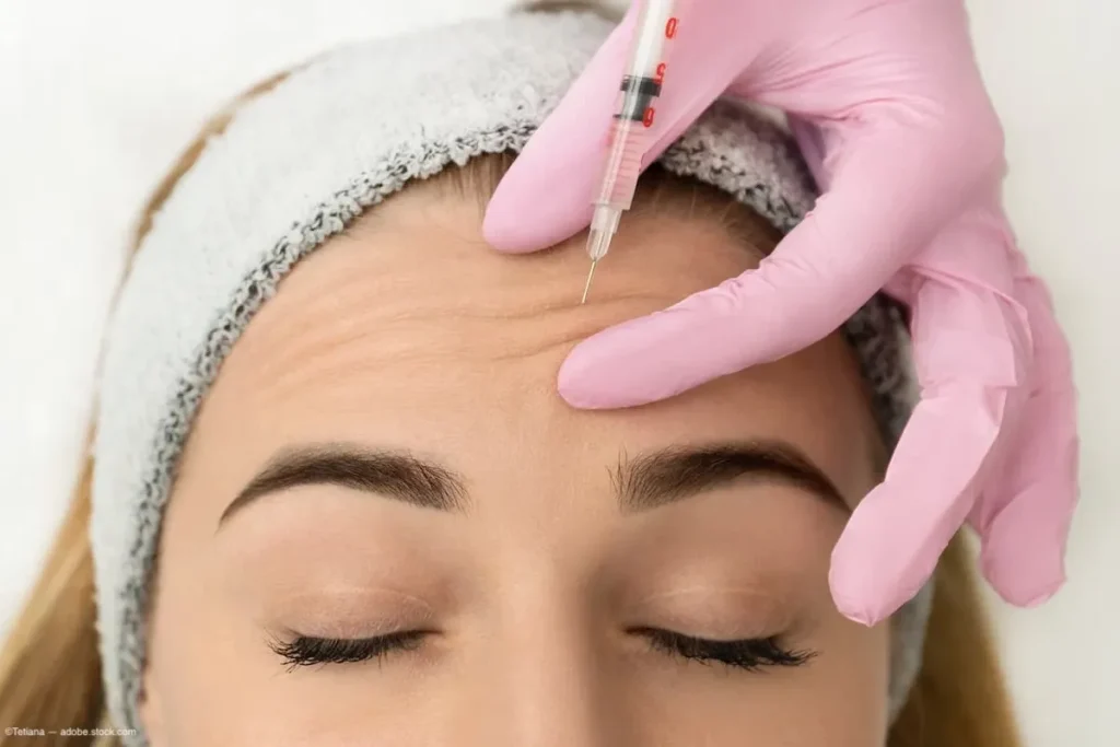 Forehead Botox Before And After: Amazing