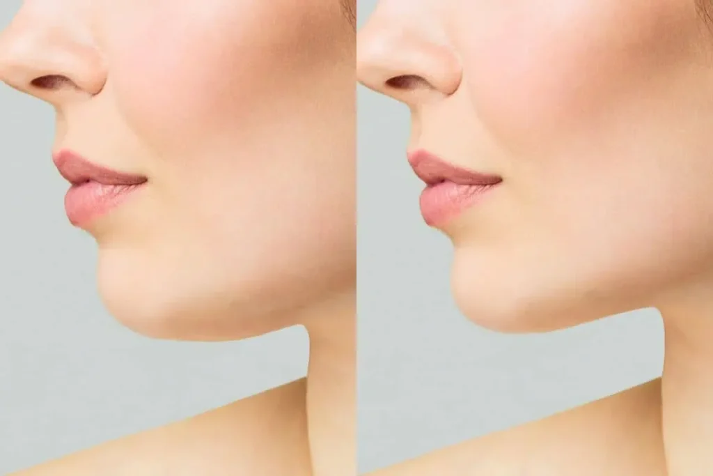 Mouth Lines Filler: Professional Results