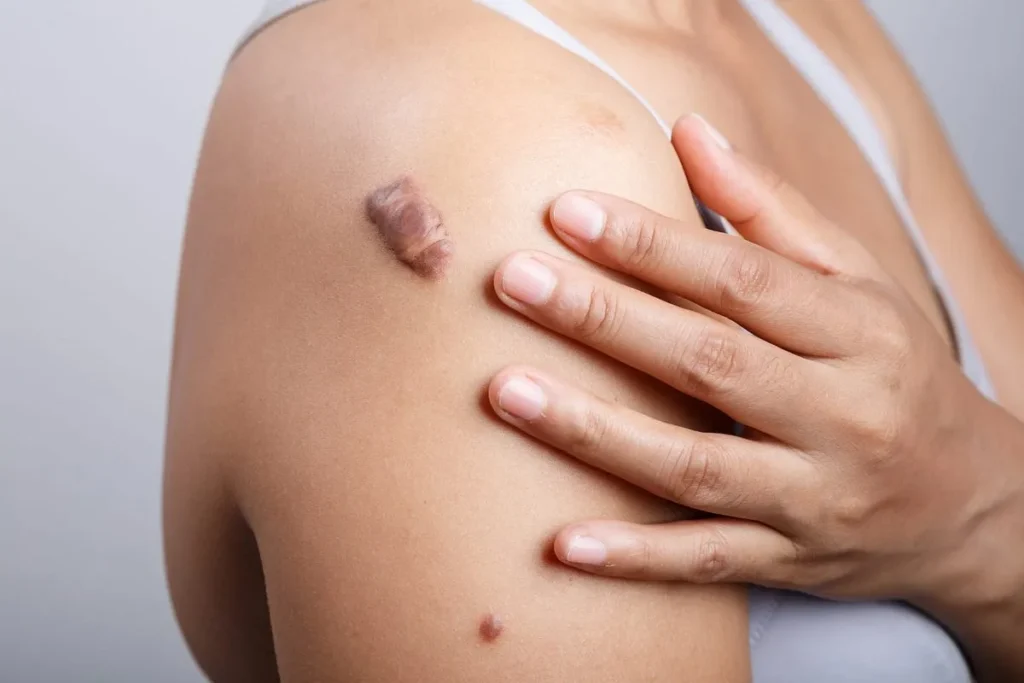 Tea Tree Oil For Scars: Amazing Relief Tips