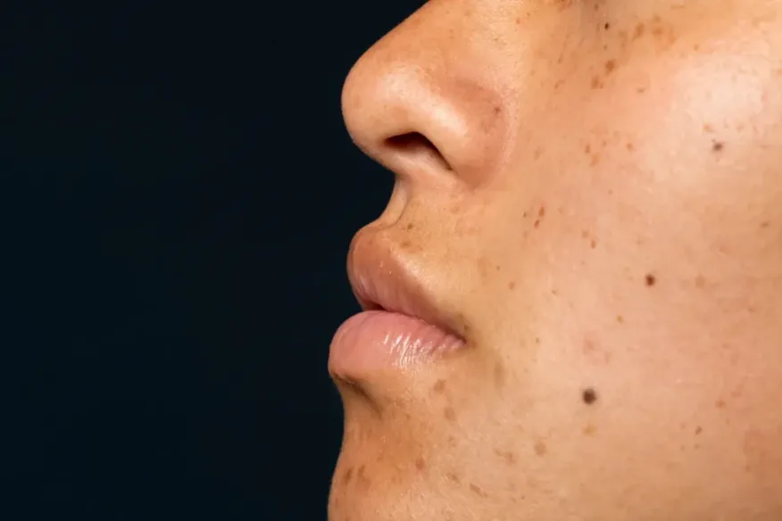 Small Black Specks On Skin: Amazing Guide