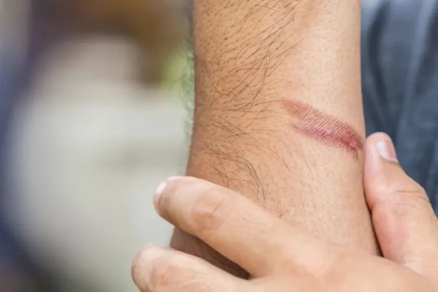 What Causes Scars? Powerful Amazing Secrets