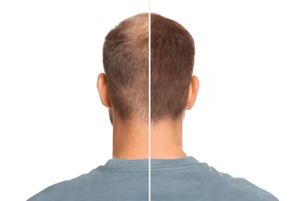 5 Months After Hair Transplant Surgery Results