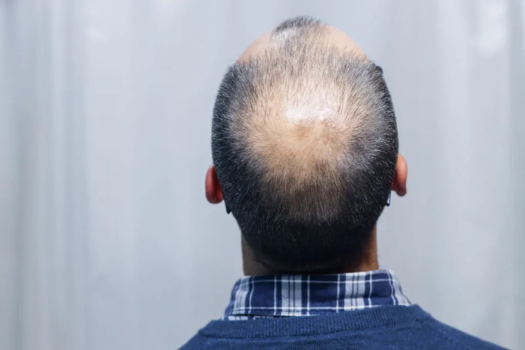 Back Of Head Hairline Female: Best Fixes