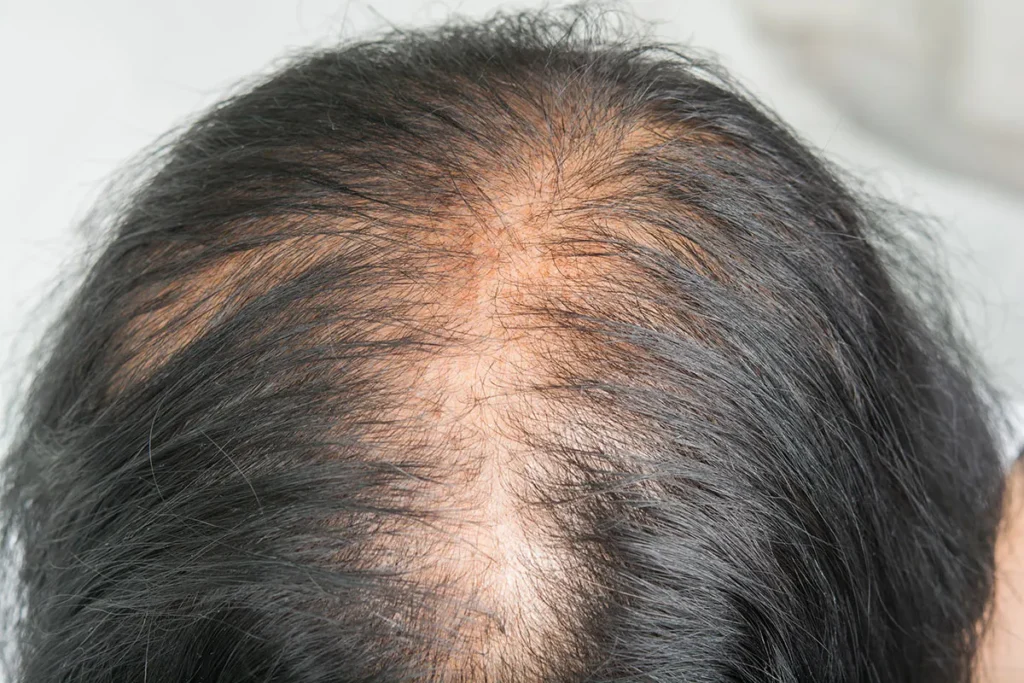 Can Baldness Be Reversed? Amazing Natural Fix