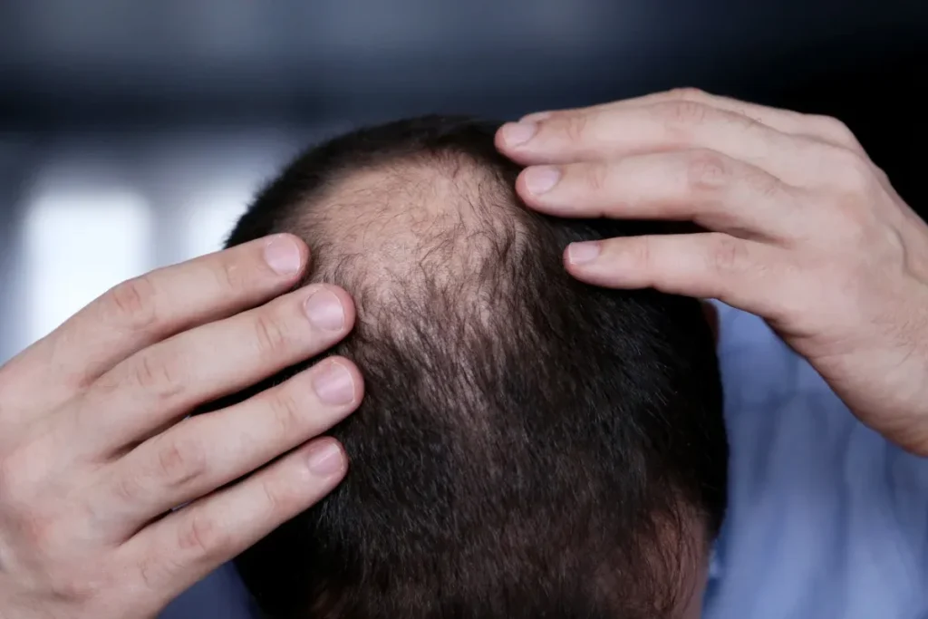 Does Alopecia Hurt? Critical Warning Signs