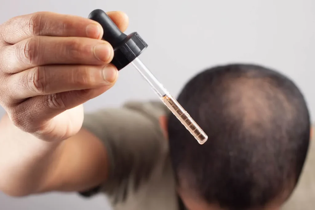 Finasteride And Minoxidil Side Effects: Info
