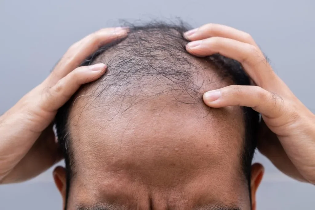 Finasteride Androgenic Alopecia: Best Cure