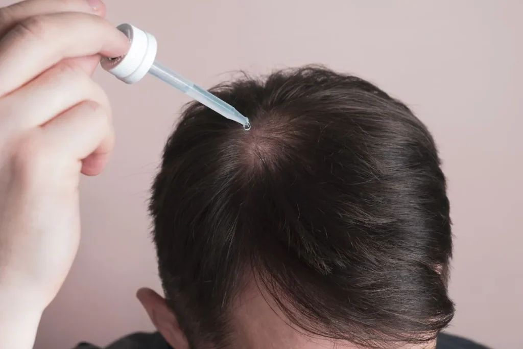 Finasteride Dose For Hair Loss: Best Tips