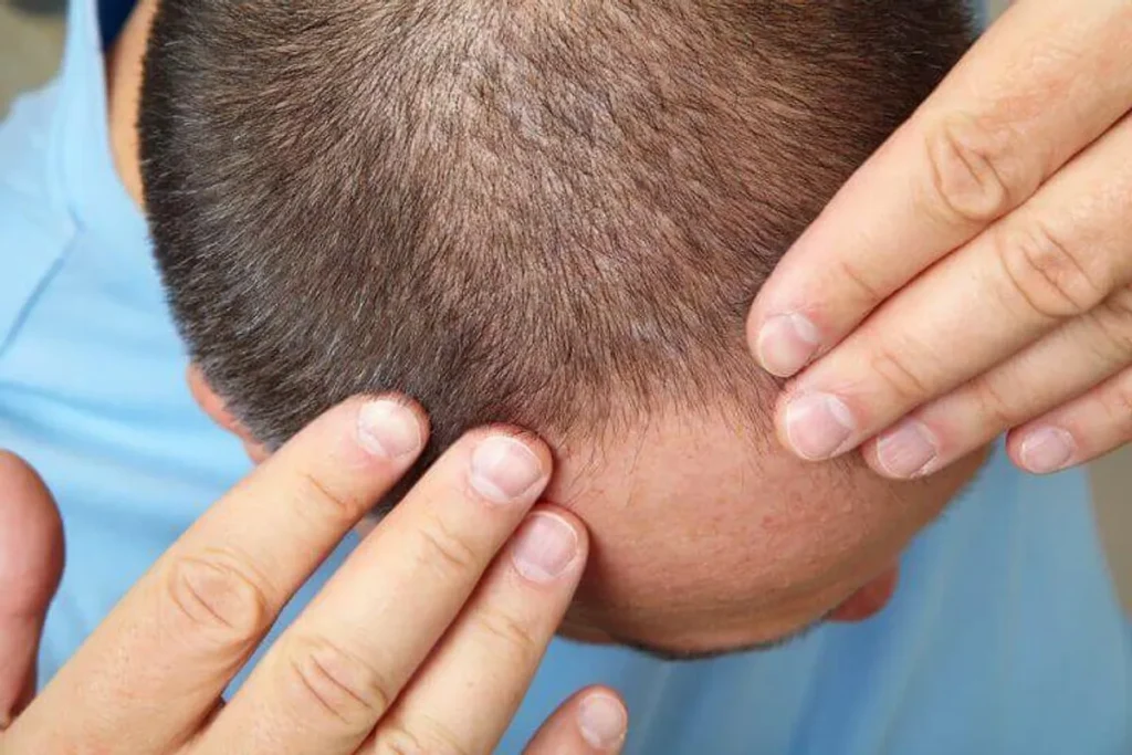 Finasteride Side Effects Women: Safety Info