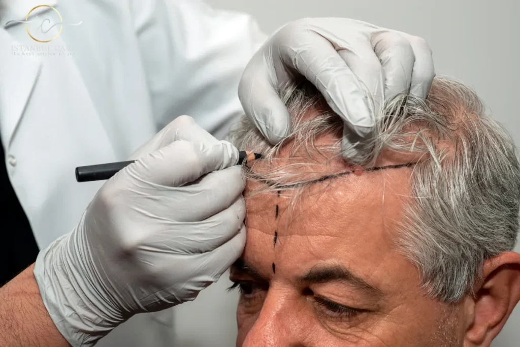 Finasteride Success Rate: Amazing Results