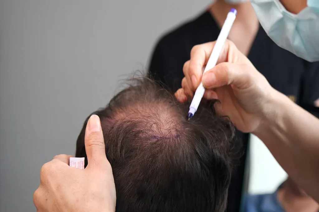 Hair Loss Due To Medication: Best Relief