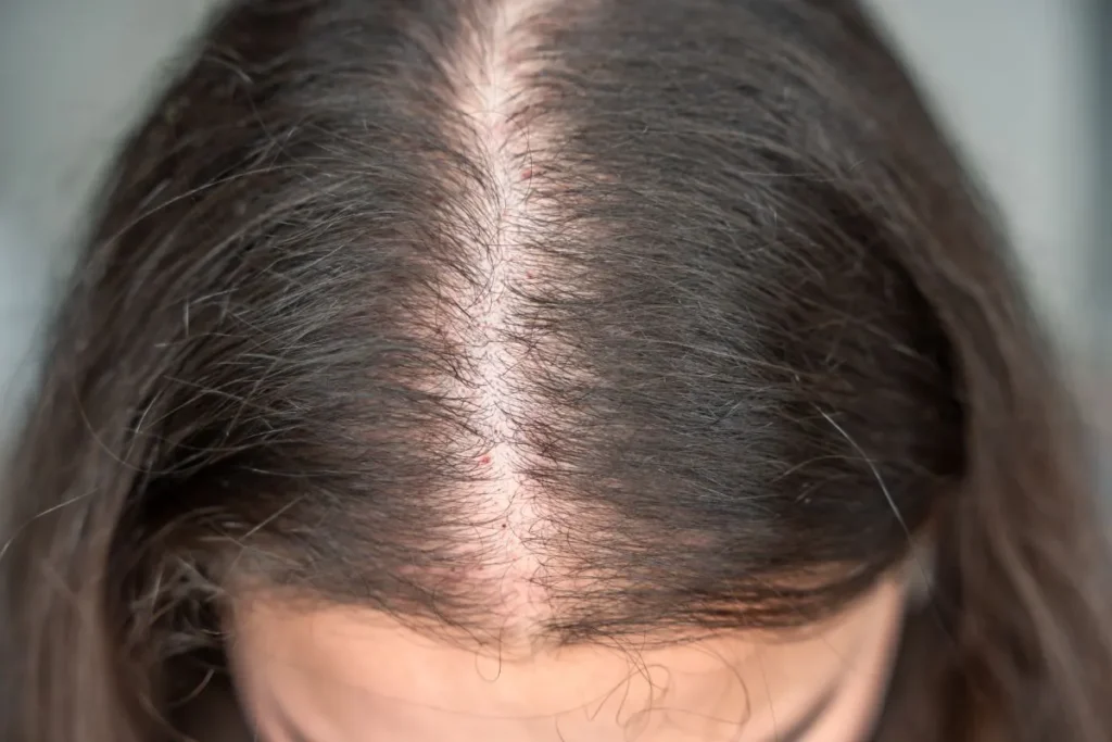 Hair Loss From Stress Remedy: Amazing Wow