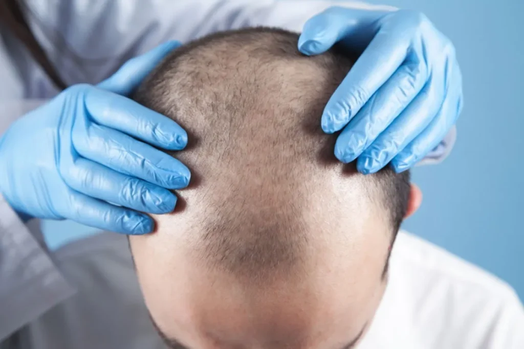 Hair Transplant 3 Months Post Op: Progress