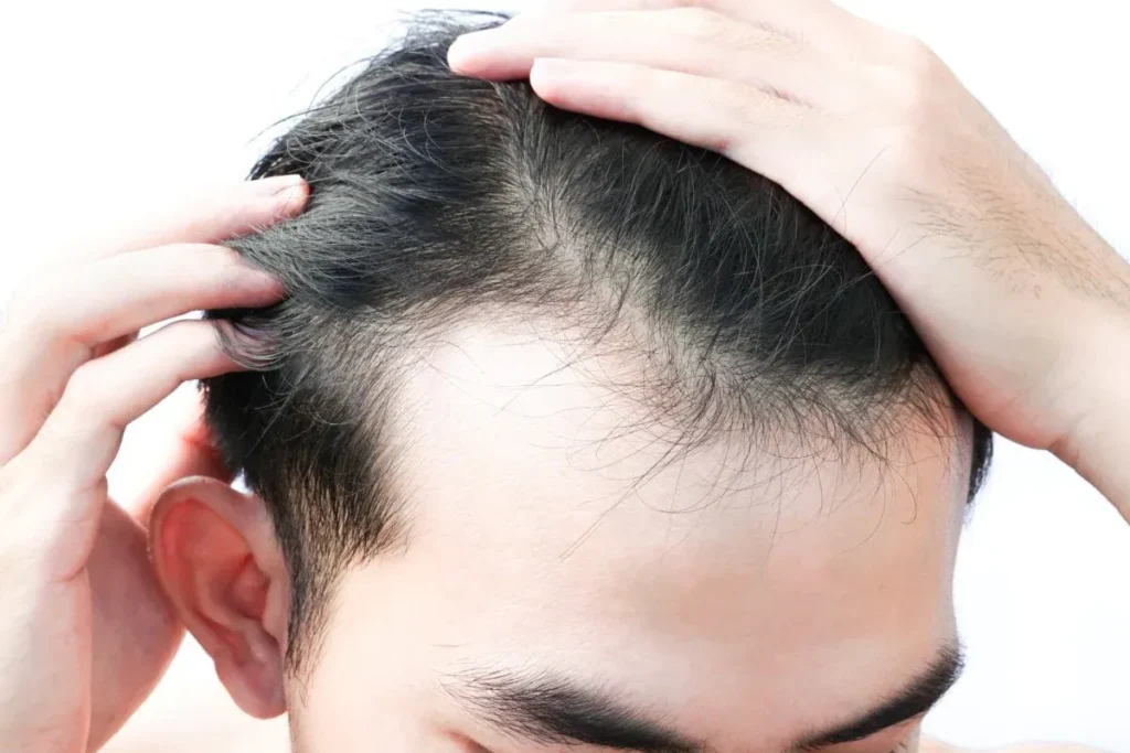 Telogen Effluvium Men: Powerful Fixes